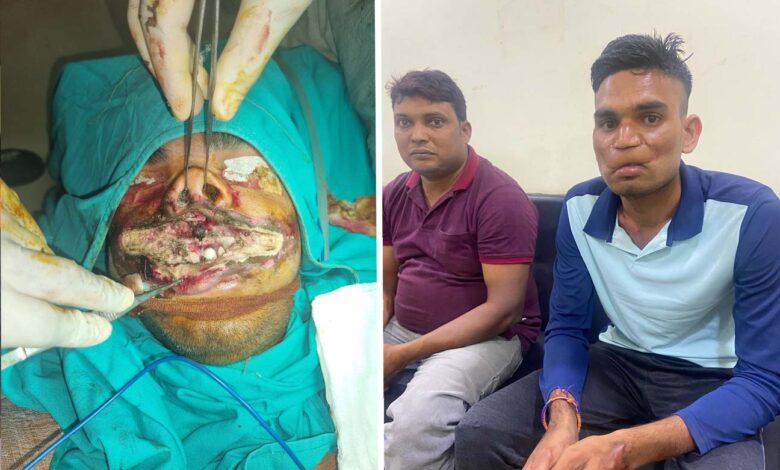 Dr. Kamlesh made lips by removing mass from back of young man's face scorched by current.