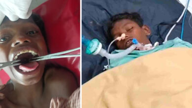 Doctors succeed in removing fish stuck in child's throat, child's condition stable.